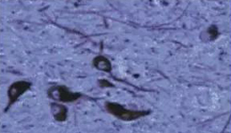 正常人：黑质神经元存在