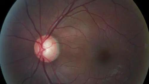 青光眼的克星来袭，助力患者远离视力的“窃贼”