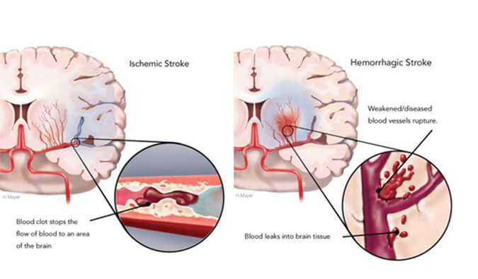 世界卒中日：从动物药效模型评价看心脑血管药物开发